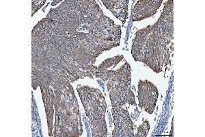 IHC analysis of S100A14 using anti-S100A14 antibody (ABIN7602920). (S100A14 antibody  (C-Term))