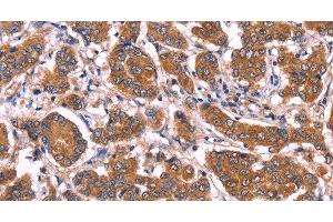 Immunohistochemistry of paraffin-embedded Human breast cancer tissue using COL20A1 Polyclonal Antibody at dilution 1:40 (COL20A1 antibody)