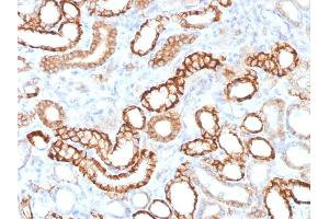 Formalin-fixed, paraffin-embedded human Renal Cell Carcinoma stained with KSP-Cadherin Rabbit Recombinant Monoclonal Antibody (CDH16/1532R) (Recombinant Cadherin-16 antibody)