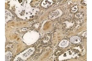 NSMAF Mouse Monoclonal Antibody at 1/100 staining human ovarian cancer by IHC-P.