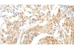 Immunohistochemistry of paraffin-embedded Human cervical cancer tissue using SEMA3D Polyclonal Antibody at dilution 1:50 (SEMA3D antibody)