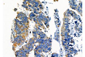 ABIN6265255 and ABIN6277135 at 1/100 staining Human colorectal cancer by IHC-P.