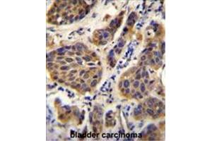 YOD1 Antibody (C-term) immunohistochemistry analysis in formalin fixed and paraffin embedded human bladder carcinoma followed by peroxidase conjugation of the secondary antibody and DAB staining. (YOD1 antibody  (C-Term))