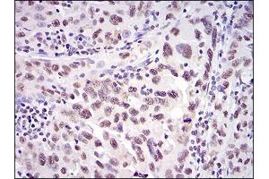 Immunohistochemical analysis of paraffin-embedded endometrial cancer tissues using XRCC6 mouse mAb with DAB staining.