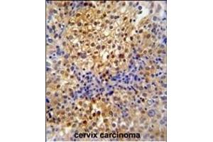 PR38A Antibody (C-term) (ABIN653884 and ABIN2843131) immunohistochemistry analysis in formalin fixed and paraffin embedded human cervix carcinoma followed by peroxidase conjugation of the secondary antibody and DAB staining.