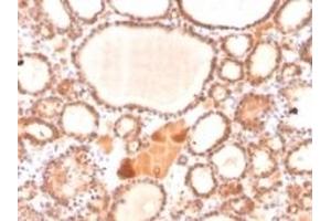 Formalin-fixed, paraffin-embedded human thyroid carcinoma stained with Glyoxalase 1 (GLO1) Mouse Monoclonal Antibody (CPTC-GLO1-1).