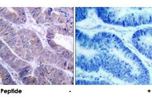 Immunohistochemical analysis of paraffin-embedded human colon carcinoma, using PRKAA1 polyclonal antibody . (PRKAA1 antibody)