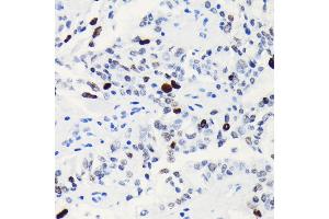 Immunohistochemistry of paraffin-embedded human oophoroma using Phospho-Histone H3-S10 antibody (ABIN3019419, ABIN3019420, ABIN3019421, ABIN1681355 and ABIN7101861) at dilution of 1:100 (40x lens).