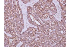 IHC-P Image Immunohistochemical analysis of paraffin-embedded human breast cancer, using HXK I, antibody at 1:250 dilution.