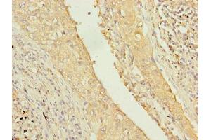 Immunohistochemistry of paraffin-embedded human lung cancer using ABIN7173950 at dilution of 1:100 (Type 2 Phosphatidylinositol 4,5-Bisphosphate 4-Phosphatase (PIP4P2) (AA 1-191) antibody)