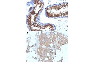 Immunohistochemical staining (Formalin-fixed paraffin-embedded sections) of (A) human testicular carcinoma and (B) human breast carcinoma with MVP monoclonal antibody, clone 1032 . (MVP antibody)