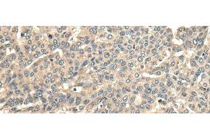 Immunohistochemistry of paraffin-embedded Human liver cancer tissue using CCDC113 Polyclonal Antibody at dilution of 1:65(x200) (CCDC113 antibody)