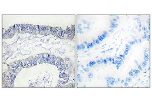 Immunohistochemistry analysis of paraffin-embedded human lung carcinoma tissue, using FA12 (heavy chain, Cleaved-Ile20) antibody. (F12 antibody  (Cleaved-Ile20, Heavy Chain, N-Term))
