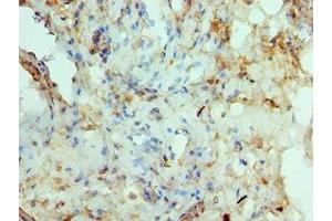 Immunohistochemistry of paraffin-embedded human prostate cancer using ABIN7150291 at dilution of 1:100 (RAD51D antibody  (AA 1-328))