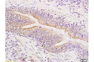 Formalin-fixed and paraffin embedded human pneumonia tissue labeled with Anti-Phospho-FAK(Tyr576/577) Polyclonal Antibody, Unconjugated (ABIN685048) at 1:200 followed by conjugation to the secondary antibody and DAB staining (FAK antibody  (pTyr576, pTyr577))