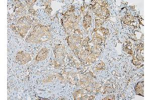 IHC analysis of IQGAP1 using anti-IQGAP1 antibody (ABIN6719262). (IQGAP1 antibody)