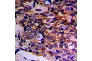Immunohistochemical analysis of MTIF3 staining in human prostate cancer formalin fixed paraffin embedded tissue section.