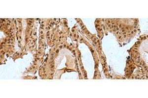 Immunohistochemistry of paraffin-embedded Human thyroid cancer tissue using BCL7B Polyclonal Antibody at dilution of 1:85(x200) (BCL7B antibody)
