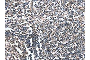 The image on the left is immunohistochemistry of paraffin-embedded Human tonsil tissue using ABIN7190052(CAMTA1 Antibody) at dilution 1/15, on the right is treated with synthetic peptide. (CAMTA1 antibody)