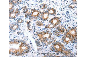Immunohistochemistry of Human stomach cancer using CLDN7 Polyclonal Antibody at dilution of 1:50