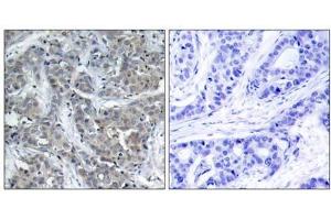 Immunohistochemical analysis of paraffin-embedded human breast carcinoma tissue, using Stathmin 1 (Ab-15) antibody (E021227). (Stathmin 1 antibody)