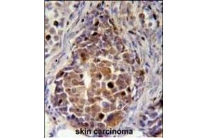RDH16 Antibody (N-term (ABIN651647 and ABIN2840343) immunohistochemistry analysis in formalin fixed and paraffin embedded human skin carcinoma followed by peroxidase conjugation of the secondary antibody and DAB staining.