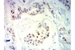 Immunohistochemical analysis of paraffin-embedded breast cancer tissues using PGR mouse mAb with DAB staining.