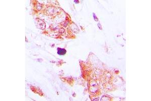 Immunohistochemical analysis of CDC42EP2 staining in human lung cancer formalin fixed paraffin embedded tissue section. (CDC42EP2 antibody  (N-Term))