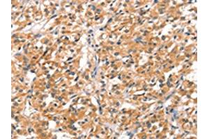 The image on the left is immunohistochemistry of paraffin-embedded Human thyroid cancer tissue using ABIN7192186(RHOBTB2 Antibody) at dilution 1/30, on the right is treated with synthetic peptide. (RHOBTB2 antibody)