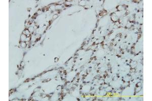 Immunoperoxidase of monoclonal antibody to RPL39L on formalin-fixed paraffin-embedded human ovary, clear cell carcinoma tissue. (RPL39L antibody  (AA 1-51))