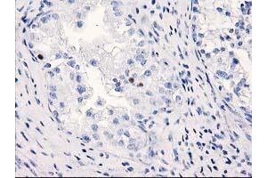 Immunohistochemical staining of paraffin-embedded Adenocarcinoma of Human ovary tissue using anti-C1orf50 mouse monoclonal antibody. (C1ORF50 antibody)