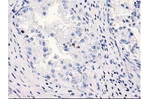 Immunohistochemical staining of paraffin-embedded Adenocarcinoma of Human ovary tissue using anti-C1orf50 mouse monoclonal antibody.