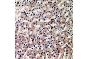 Immunohistochemical analysis of CIDEB staining in human liver cancer formalin fixed paraffin embedded tissue section.