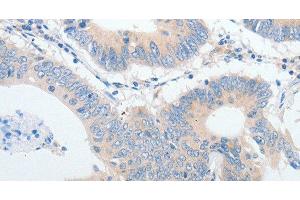 Immunohistochemistry of paraffin-embedded Human colon cancer using IGFBP1 Polyclonal Antibody at dilution of 1:30 (IGFBPI antibody)