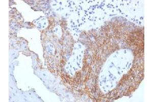 IHC testing of FFPE human tongue carcinoma with CD44v9 antibody (clone CD44v9/1459). (CD44v9 antibody)