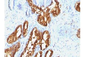 Formalin-fixed, paraffin-embedded human Prostate Carcinoma stained with PSAP Mouse Monoclonal Antibody (ACPP/1338). (ACPP antibody)
