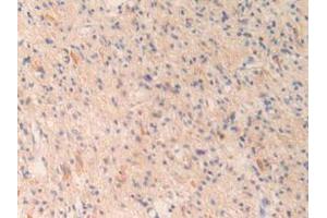 IHC-P analysis of Human Glioma Tissue, with DAB staining. (OIT3 antibody  (AA 297-506))