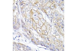 Immunohistochemistry of paraffin-embedded human esophageal cancer using SEMF Rabbit pAb (ABIN6132835, ABIN6147521, ABIN6147522 and ABIN6214683) at dilution of 1:200 (40x lens). (SEMA4F antibody  (AA 280-420))