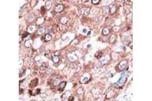 IHC analysis of FFPE hepatocarcinoma cancer tissue stained with the Bak antibody (BAK1 antibody  (AA 56-91))
