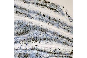 Immunohistochemical analysis of c-Myc staining in human colon cancer formalin fixed paraffin embedded tissue section. (c-MYC antibody  (C-Term))