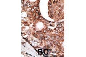 Formalin-fixed and paraffin-embedded human cancer tissue reacted with the primary antibody, which was peroxidase-conjugated to the secondary antibody, followed by DAB staining. (MLLT6 antibody  (C-Term))