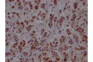 IHC image of ABIN7127781 diluted at 1:100 and staining in paraffin-embedded human breast cancer performed on a Leica BondTM system. (Recombinant PTBP1 antibody)