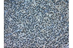 Immunohistochemical staining of paraffin-embedded Carcinoma of pancreas tissue using anti-STAT1mouse monoclonal antibody. (STAT1 antibody)