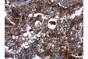 IHC-P Image VCAM1 / CD106 antibody detects VCAM1 / CD106 protein at cell membrane in human endometrial carcinoma by immunohistochemical analysis. (VCAM1 antibody)