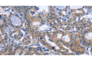 Immunohistochemistry of paraffin-embedded Human thyroid cancer tissue using UCK1 Polyclonal Antibody at dilution 1:50 (UCK1 antibody)