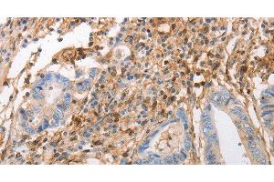 Immunohistochemistry of paraffin-embedded Human colon cancer using INA Polyclonal Antibody at dilution of 1:50 (INA antibody)