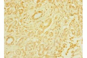 Immunohistochemistry of paraffin-embedded human pancreatic cancer using ABIN7171535 at dilution of 1:100 (TAS1R3 antibody  (AA 400-570))