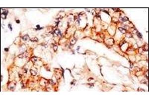 Formalin-fixed and paraffin-embedded human breast carcinoma reacted with anti-PBP1 Antibody (C-term), which was peroxidase-conjugated to the secondary antibody, followed by DAB staining. (NAE1 antibody  (C-Term))