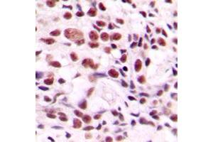 Immunohistochemical analysis of CstF-64 staining in human breast cancer formalin fixed paraffin embedded tissue section. (CSTF2 antibody  (N-Term))