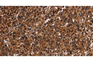 Immunohistochemistry of paraffin-embedded Human liver cancer tissue using MAGEC2 Polyclonal Antibody at dilution 1:40 (MAGEC2 antibody)